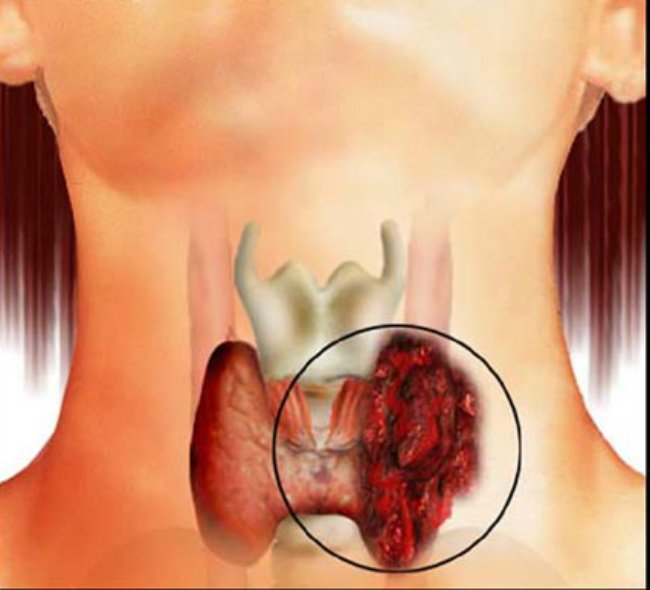 папилярный рак щитовидки