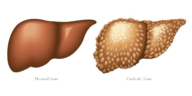сравнение здорой печени и с циррозом