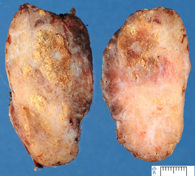 щитовидная железа, пораженная папиллярным раком