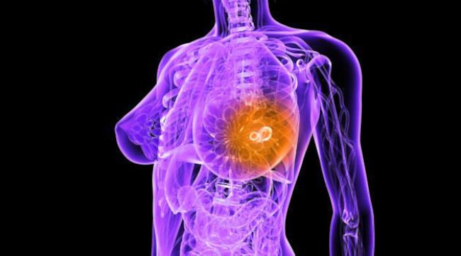 рак молочной железы графика