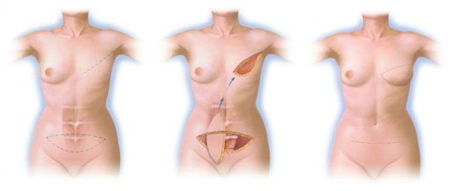 восстановление груди после операции