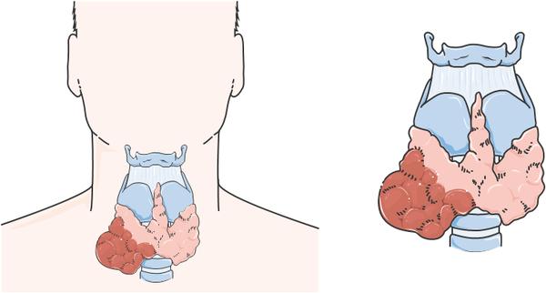 опухоль щитовидной железы