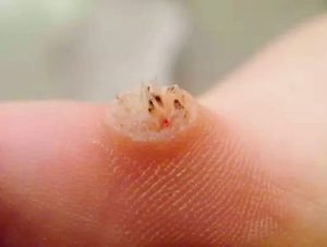 Папиллома – вирусное заболевание кожи Папиллома – вирусное заболевание кожи