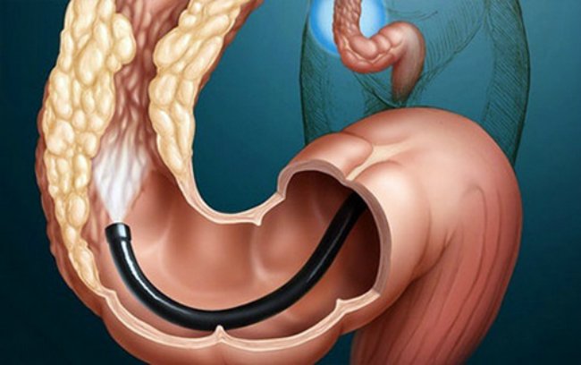 Cancer gut traditional methods of treatment Cancer gut traditional methods of treatment