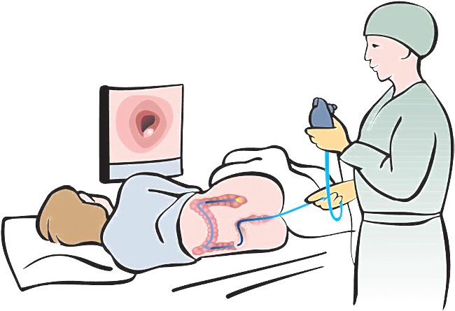диагностика аденокарциномы толстой кишки