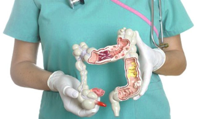 врач держит модель кишечника с аденокациомой