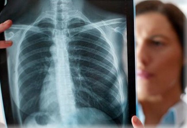 врач держит снимок легких