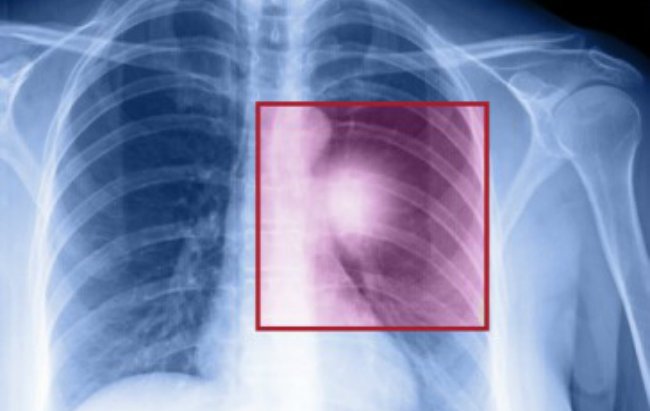 опухоль в легких