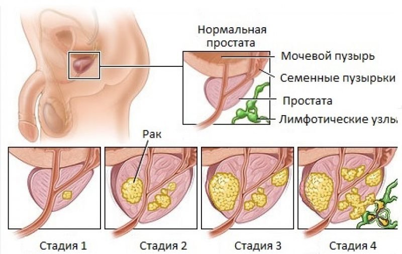 Классификация TNM