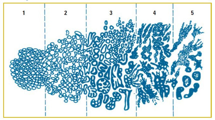 Шкала Глисона