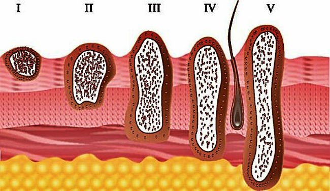 стадии меланомы