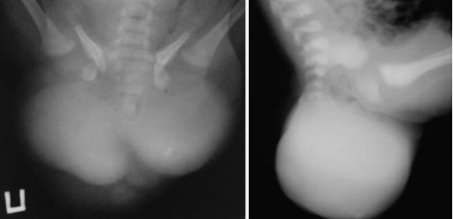 тактика лечения крестцово-копчиковой тератомы
