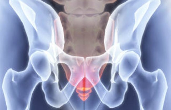 крестцово-копчиковая тератома