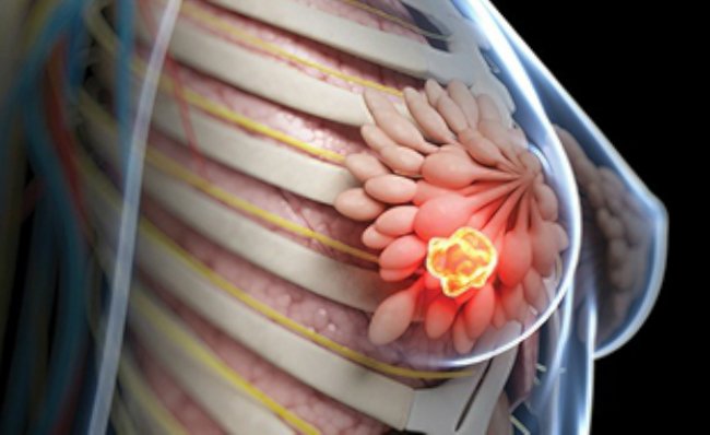 саркома рака груди графика