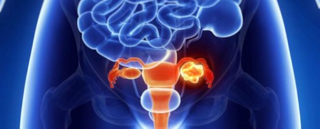 зрелая тератома