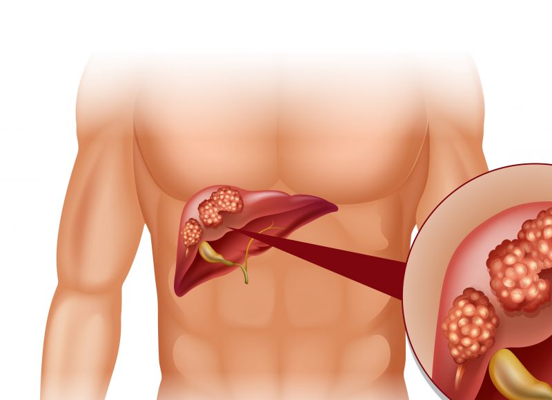 Болезнь пищеварительной системы