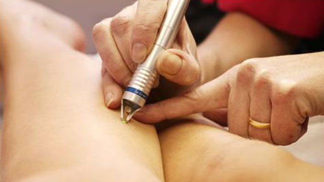 Родинки. Преимущество удаление лазером