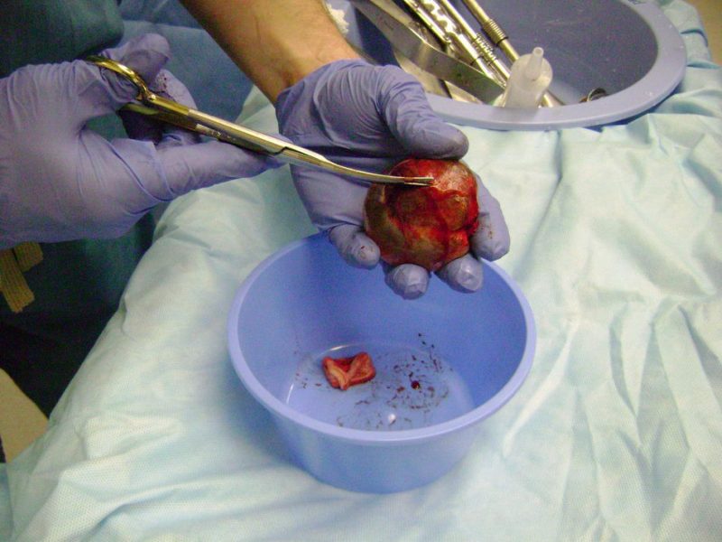 Удаленная опухоль