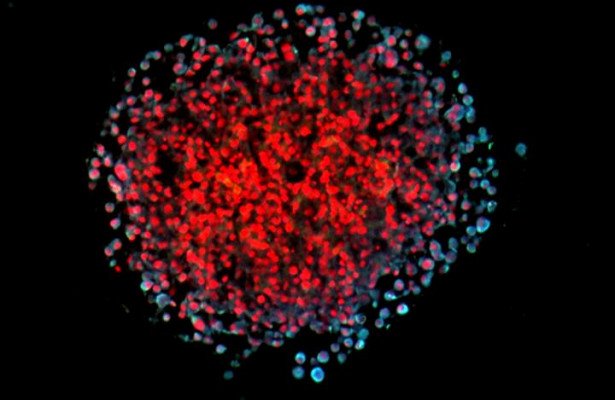 Найдена связь ожирения и рака молочной железы