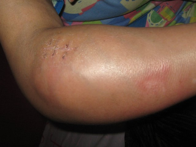 Опухоль руки