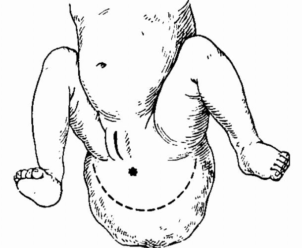 Образование в крестцовом отделе