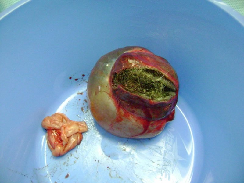 Удаленная опухоль