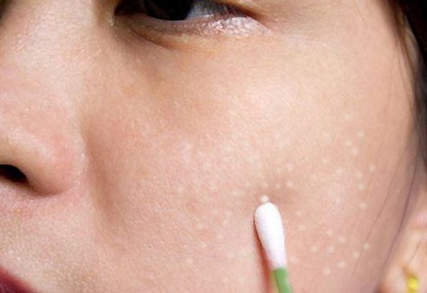 Как избавиться от акне самостоятельно