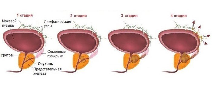 Стадии заболевания