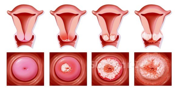Этапы заболевания