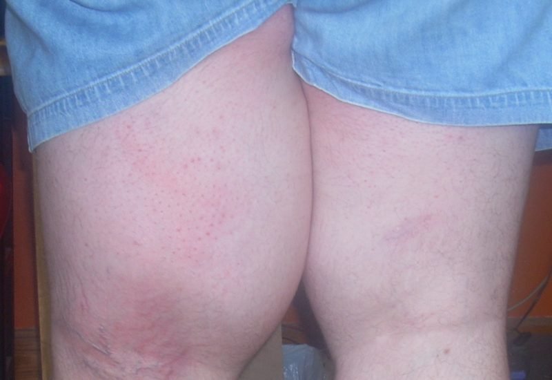 Пациент с заболеванием