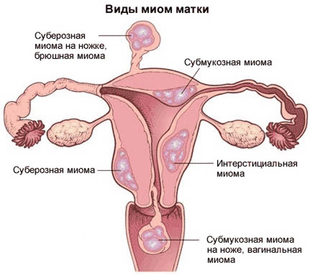 Субсерозная лейомиома матки