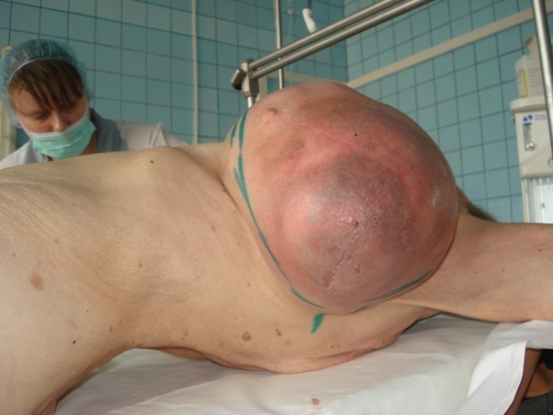 Тяжелая стадия болезни