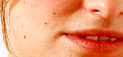 Способы удаления невуса