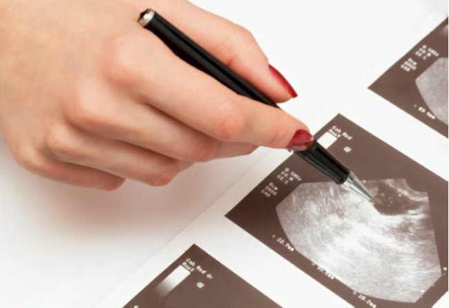 снимок яичника