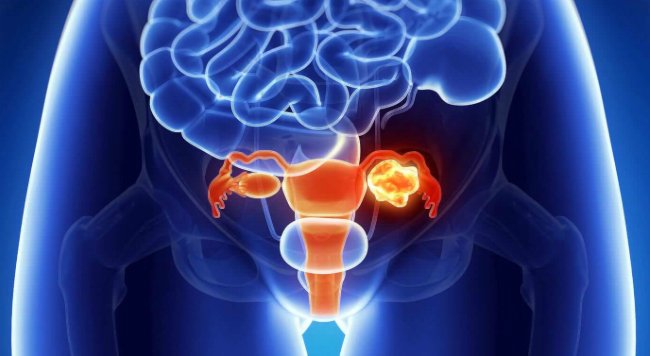 рак яичников графика