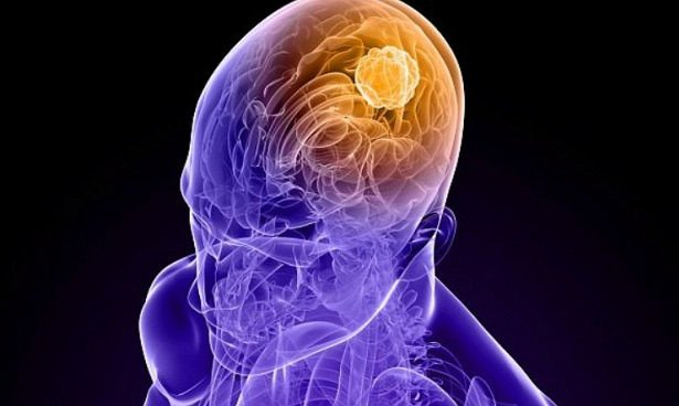 Генная терапия лечит смертельный рак мозга