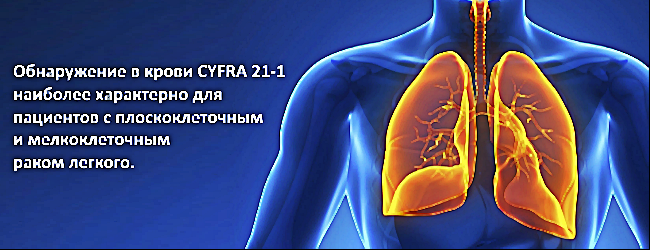Cyfra 21-1 говорит о раке легкого